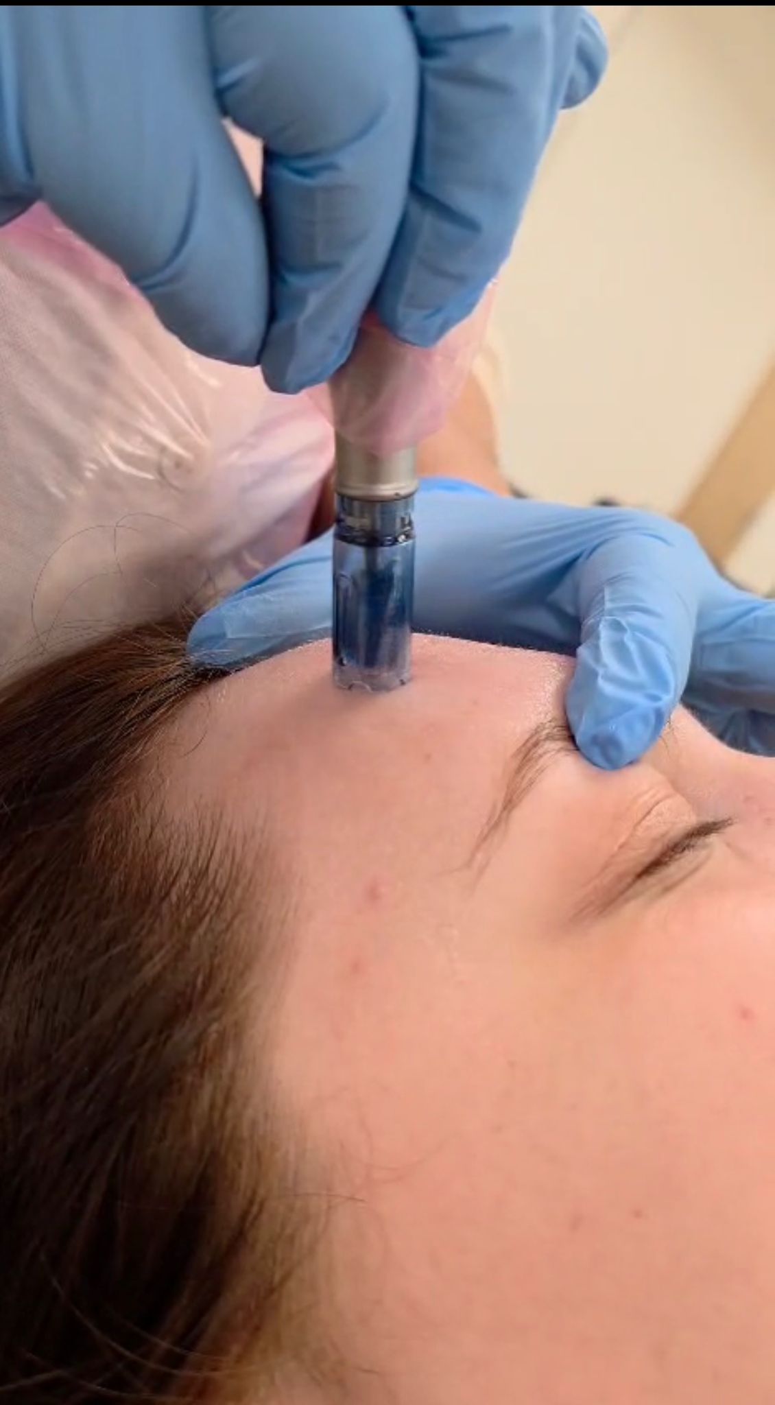 Microneedling advanced skin treatment Surrey